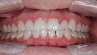 How Offering Special Offers on Whitening for Your Orthodontic Cases Helps to Increase Uptake