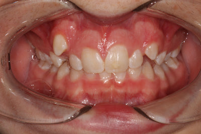 Evolve Brackets Case Study: Correction of a Class II Division II Malocclusion on a Mild Skeletal II Base