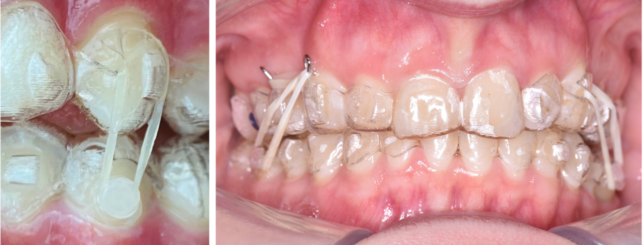 Incorporating Button Auxiliaries with Aligners for Severe Rotations