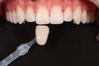 Incorporating tooth whitening into your orthodontic cases