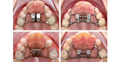 Evolution of the Leaf Expander: A Maxillary Self Expander