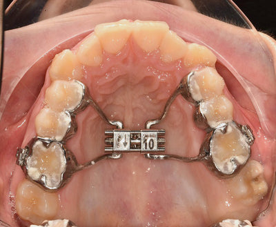 Case Study using 3D Printed Metal Palatal Expander by Dr Richard Cousley.