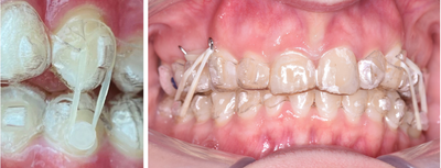 Three Reasons I Use Aligner Auxiliaries: Dr Aisling Byrne's Protocols & Case Photos