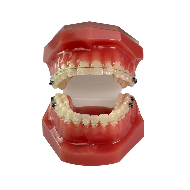 Cosmetic Consultation Model with Evolve Composite Brackets