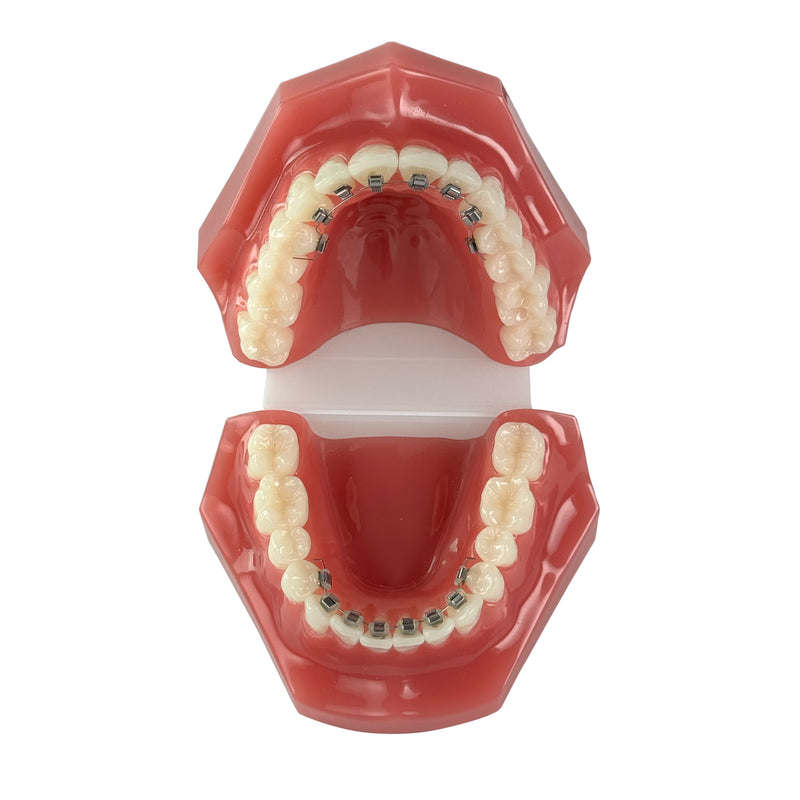 Finesse Brackets - Lingual Consultation Model