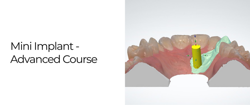 Mini Implant -  Advanced Course - 4 June 2025