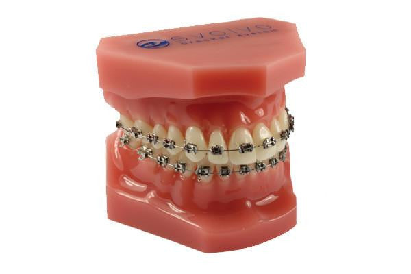 Consultation Model with Evolve Mini Stainless Steel Brackets