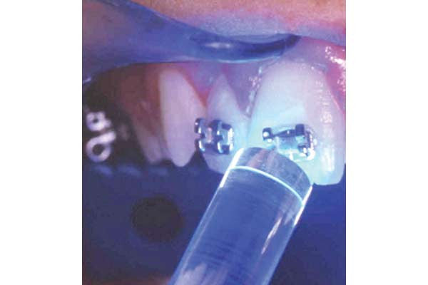 Dental Curing Light - Mini LED Curing Light