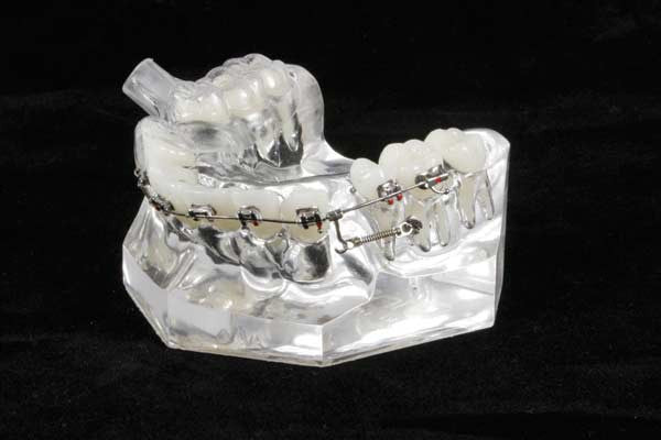 Mini Implant Educational Model