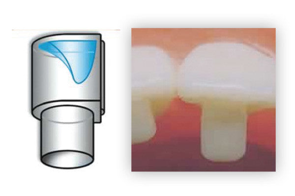 Bite Ramp Retainers Mini-Mold Bite Ramp Kit – DB Orthodontics Limited
