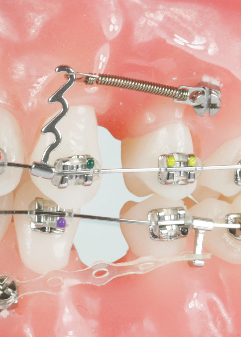 Orthodontic Crimpable Hook Spiral Dental Hook for Braces - China Dental Hook  for Braces, Orthodontic Crimpable Hook Spiral